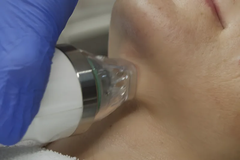 RF-microneedling med guldnålar